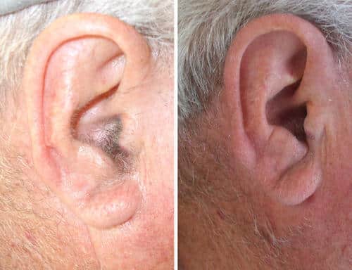 ear laser hair removal treatment 500x500 1