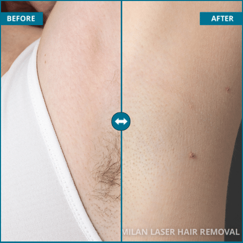 Laser Hair Removal Before and After #2