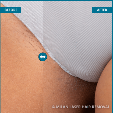Laser Hair Removal Before and After #3