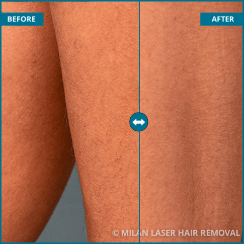 Laser Hair Removal Before and After #4