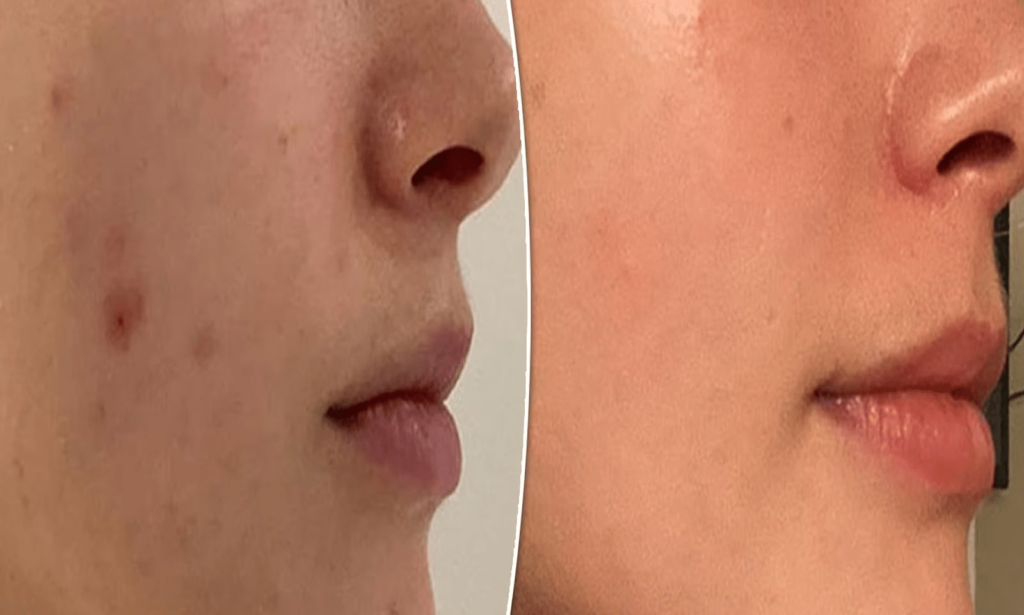 LYMA Laser Before and After